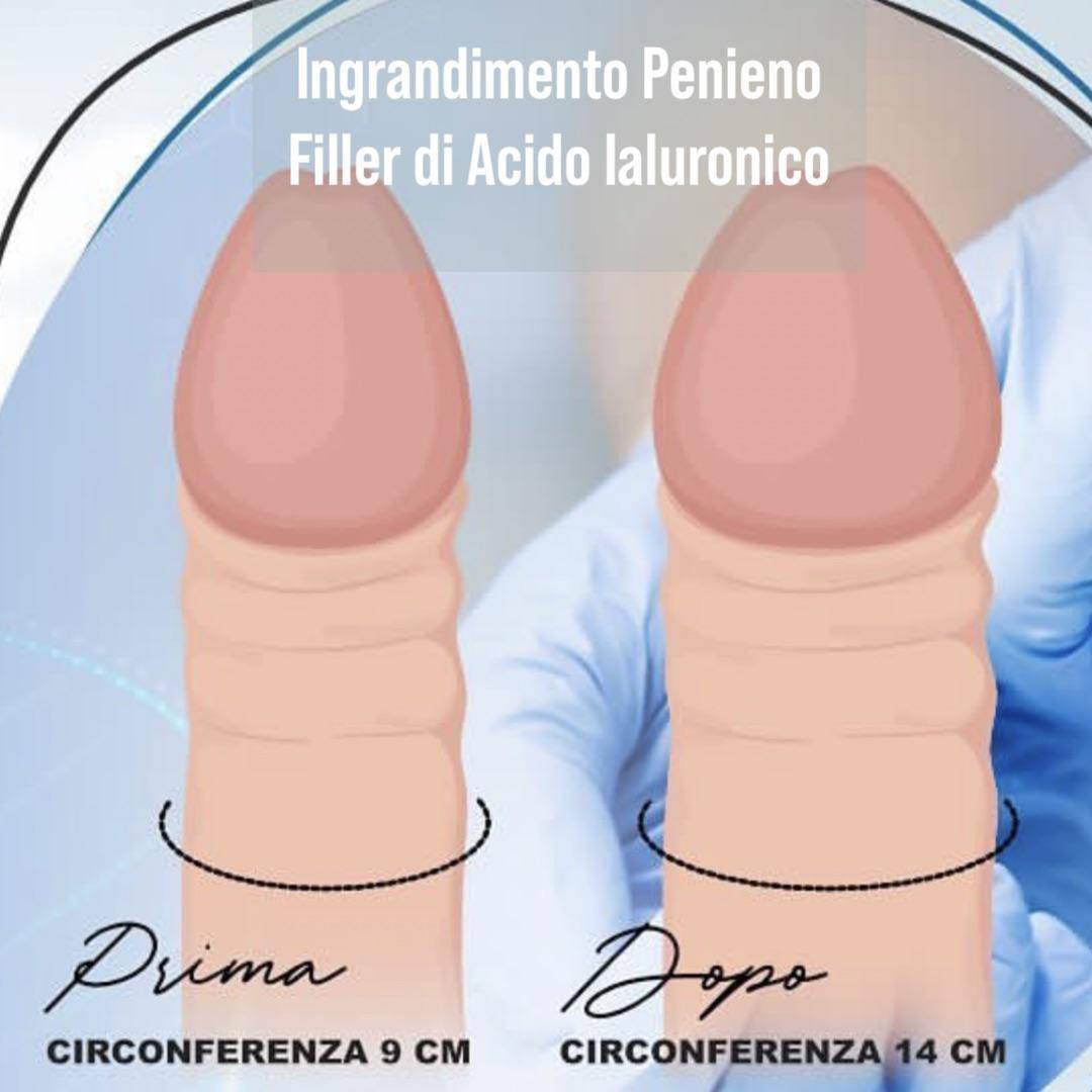Trattamento medicina estetica Aumento Penieno Non Chirurgico - Filler Pene Giulio Lotti Medico Chirurco estetico