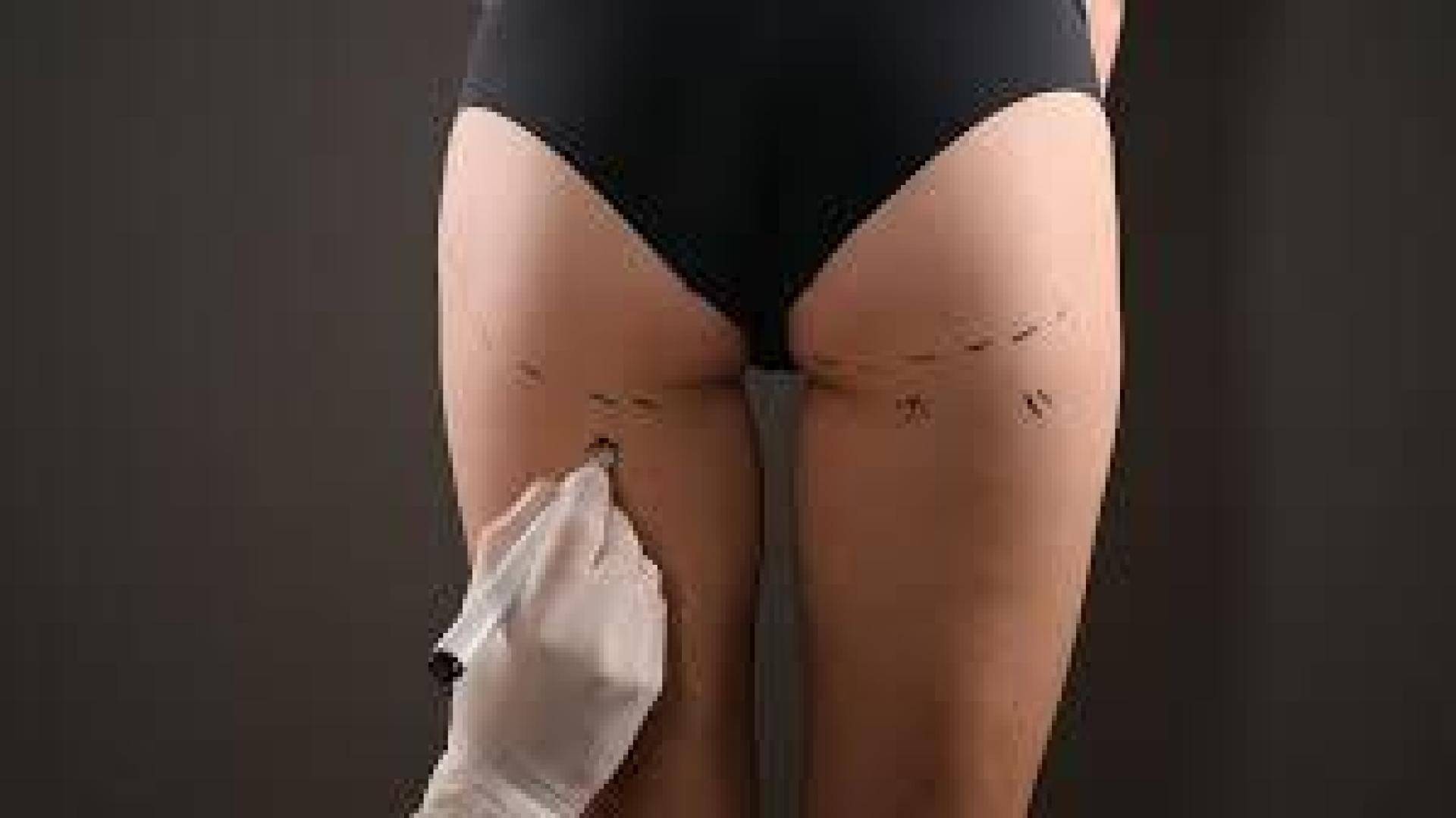 Trattamento medicina estetica Rimodellamento Glutei con Lipostruttura Giulio Lotti Medico Chirurco estetico